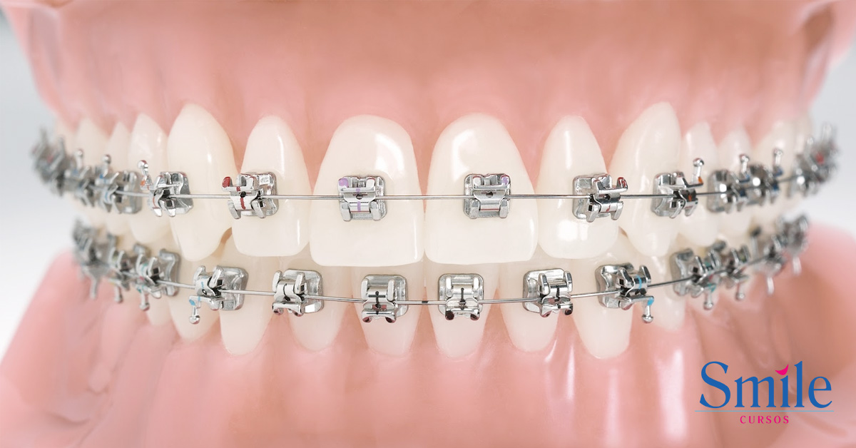 Aparelho autoligado preço, tratamento e vantagens Smile Cursos